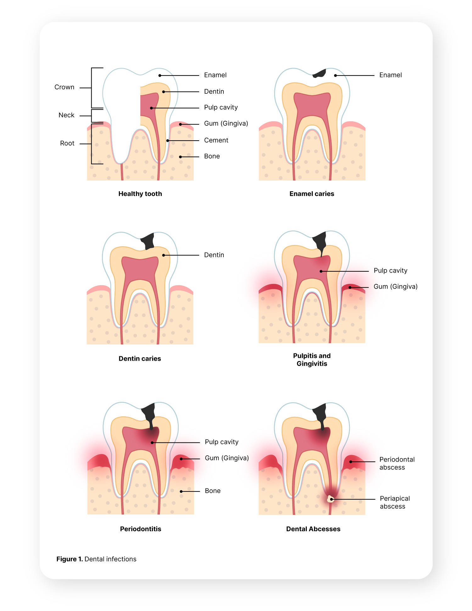 Dental infections