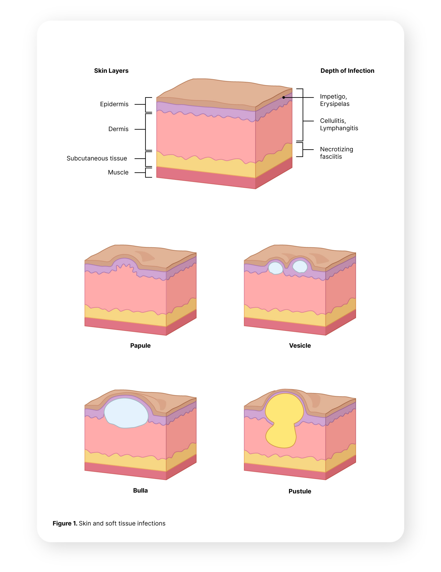 Skin and soft tissue infections